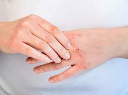 The delta covid variant first seen in india is now dominant in the uk.a delay of lockdown lifting in england is on the cards, leaving millions with qu. Skin Rashes Coronavirus Symptom Skin Rashes Can Be A Sign Of Covid 19 As Per Study
