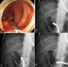 A Double Guidewire Technique To Facilitate Deep Cannulation And Stenting In A Patient With Altered Gastrointestinal Anatomy Kawabata Journal Of Medical Cases Used for endoscopic stent placement to drain obstructed biliary ducts. altered gastrointestinal anatomy