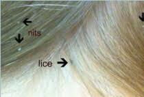 The fact is, however, that being dirty has nothing to do with having lice and being perfectly clean does nothing to protect you from lice. Head Lice Facts 101 Do S Don Ts What No One Tells You