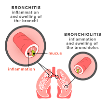 Image result for Acute Bronchitis