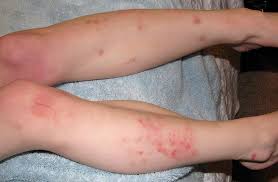 Eczema is a condition when your skin becomes inflamed and develops rough, cracked, itchy, and red patches. Severe Eczema Effectively Treated With Xeljanz Tofacitinib An Arthritis Drug In Small Study