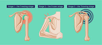 Image result for Frozen Shoulder
