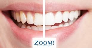 How much does zoom whitening cost. Teeth Whitening Traralgon Teeth Whitening Gippsland Teeth Bleaching