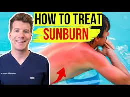 Image result for Sunburn