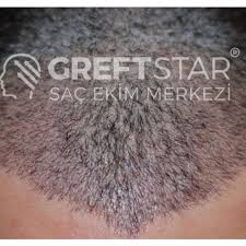 Greft Star Adli Kullanicinin Sac Ekimi Samsun Panosundaki Pin Instagram Sac