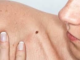 Sun exposure and having a weak immune system can affect the risk of merkel cell carcinoma. Merkel Cell Carcinoma Outlook Treatment Stages And More
