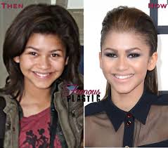 Zendaya Plastic Surgery Nose Job Rhinoplasty New Look Plastic Surgery Nose Job Cosmetic Surgery