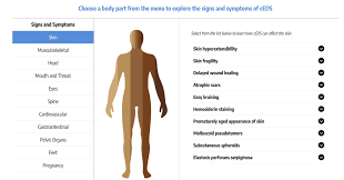 Image result for Hypermobility Signs
