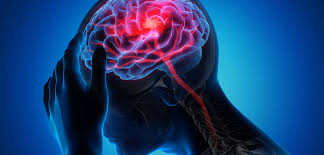 L'emorragia cerebrale è una sindrome neurologica acuta dovuta alla rottura di un vaso arterioso cerebrale e al conseguente stravaso di sangue nel parenchima cerebrale. Meningiomi E Aneurisma Cerebrale Cause E Terapie Cm Santa Tecla
