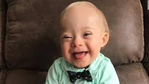 This Is Lucas The First Gerber Baby With Down Syndrome Cnn Down Syndrome Baby Down Syndrome Kids Down Syndrome