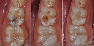 What To Do If Your Filling Falls Out Dental Fillings Root Canal Treatment Tooth Filling