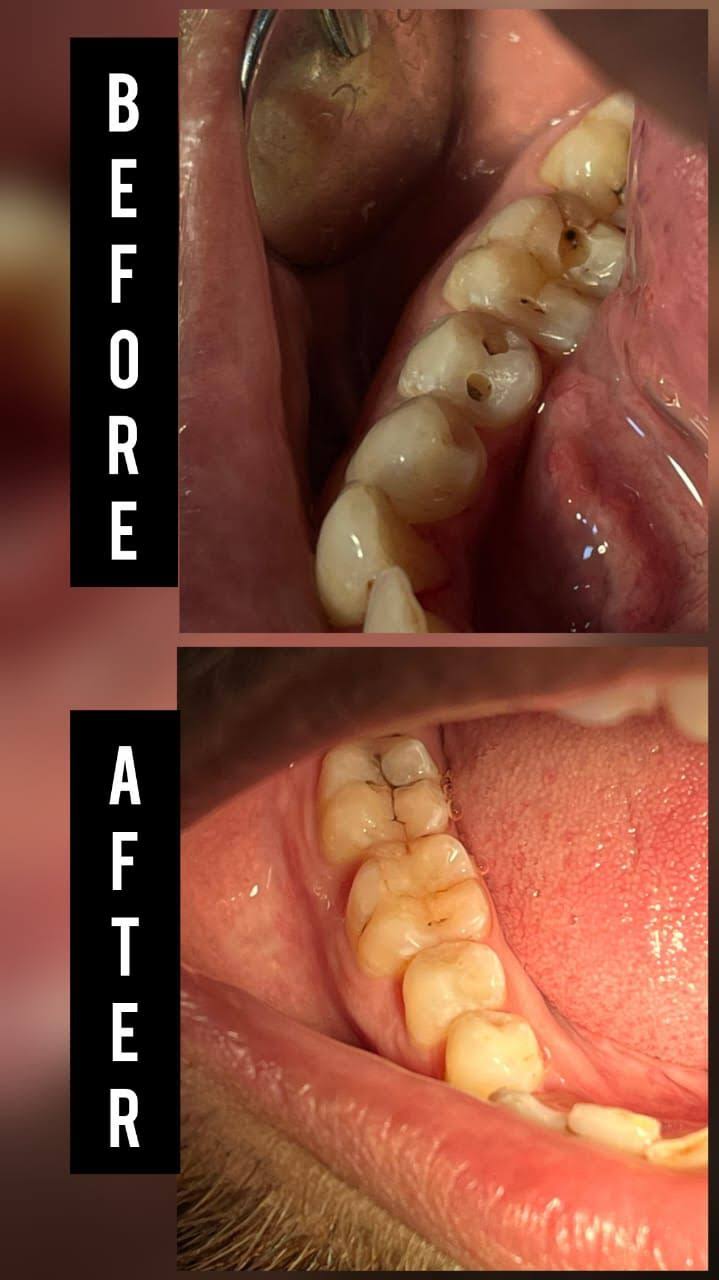 Composite Filling product image
