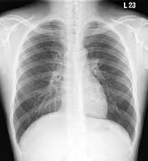Image result for Relapsing Polychondritis