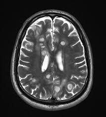 Image result for Brain Abscess