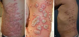Metastatischer Morbus Crohn Springerlink