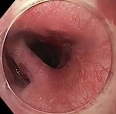 Check spelling or type a new query. Management Of Zenker S Diverticulum Using Flexible Endoscopy Videogie