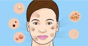 Gozenekleri Acarak Cilt Lekelerini Gideren 9 Dogal Maske Viraliste Com Argan Yagi Maskeler Dogal