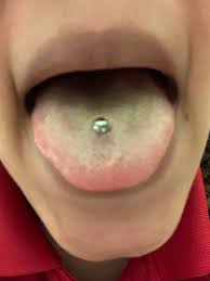 An infected tongue piercing shows some visible symptoms you can observe. Is My Tongue Piercing Infected Piercing