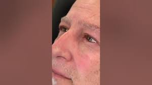 Stent Removal After Lacrimal Tear Duct Surgery