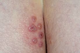 Cuz i know u can get hsv1 in funny spots: Genital Herpes Nhs