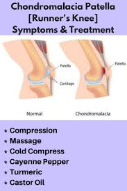 Chondromalacia Exercises Naturally Patella Treat How To Treat Chondromal Chondromalacia Patella Exercises Chondromalacia Patellofemoral Syndrome Exercises