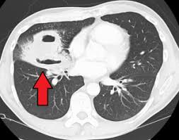 Image result for Lung Abscess