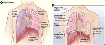The relationship between smoking and mesothelioma is one that has brought up much confusion over the years. Find Out About Symptoms Diagnosis And Treatments For Mesothelioma Action On Asbestos Industrial Injury Disease