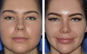 A natural procedure that involves the harvest of fat from areas such as the stomach, hips and thighs to be grafted to the face,. Jawline Lipo Contouring Gallery Beverly Hills Ghavami Plastic Surgery