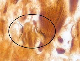Lyme Carditis Lyme Disease Cdc