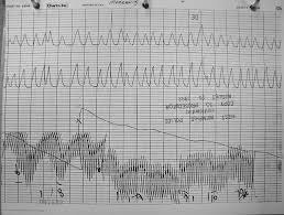 Christoper Morgan Polygraph Charts May 17 1993