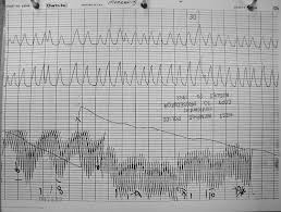 Christoper Morgan Polygraph Charts May 17 1993