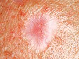 The skin appears shiny and taut, often with poorly defined borders. Is It Skin Cancer Cbs News