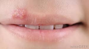 What Can Cause A Lip Rash With Pictures
