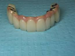 However, if your jawbone has shrunk significantly, adhesive may be the only way to help retain your dentures. Fixed Dental Implant Bridge Vs Implant Denture What Is The Real Difference Ramsey Amin Dds