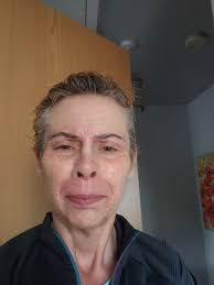 How to reduce redness and get rid of acne craters