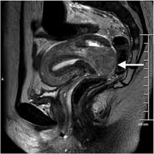 Image result for Uterine Inversion