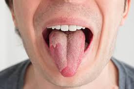 Image result for oral thrush symptoms roof of the mouth
