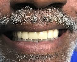 We did not find results for: Dentures In Tampa Fl Smile Gallery Carrollwood Dentist