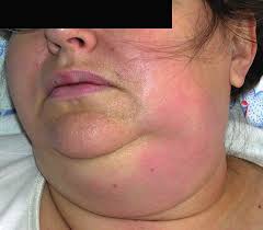 Image result for phlegmon on face)