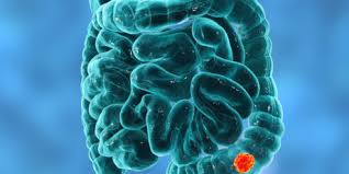When nausea and vomiting are symptoms of colon cancer, it's usually because a tumor is causing a bowel obstruction. Colon Cancer Symptoms Diagnosis And Treatment Ichilov Clinic