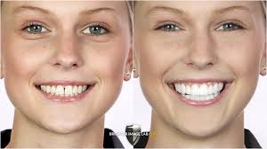 El sitio oficial de Brighter Image Lab. Pedido auténtico PressOn Veneers,  BIL Veneers, e IncrediBIL Veneers. Opciones de financiación disponibles.