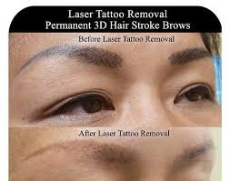 Laser tattoo removal is a huge part of our healthcare service at apple wellness. Laser Tattoo Removal Buffalo New York Scar Removal Cream On Tattoo