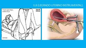 Las legras que se usan en una dilatación y legrado pueden ser filosas o usar succión. Lui Legrado Uterino Instrumental Y Ameu
