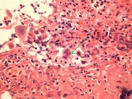 ■ мрт головного мозга в режиме т1. Pathology Outlines Herpes Simplex Esophagitis