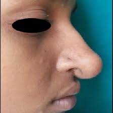 MRI showing hypodense mass lesion involving nasal tip.