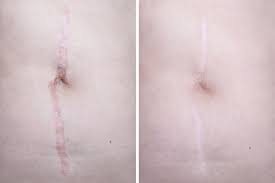 Scar Revision Surgery Preparation Recovery Long Term Care