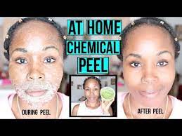 How To Make A Natural Chemical Peel At Home Erase Acne Wrinkles Dark Spots Youtube Chemical Peel Chemical Peel At Home Skin Peeling On Face