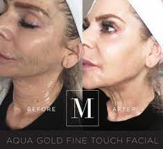 Aquagold microinfusion is an effective solution for treating sensitive areas including around the eyes and mouth, forehead, back of hands, and neck. Aquagold Baby Botox Aesthetics Glow
