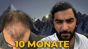 It looks like you're using artstation from great britain. Haartransplantation Vorher Nachher 10 Monate Youtube