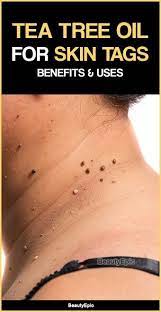 How To Remove Skin Tags With Tea Tree Oil Tea Tree Oil Skin Skin Tag Removal Skin Tags Essential Oils